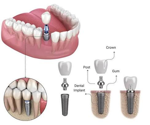 Dental Implants