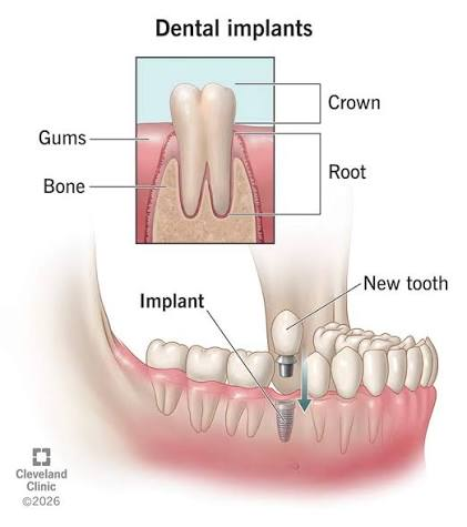 Affordable Dental Implants